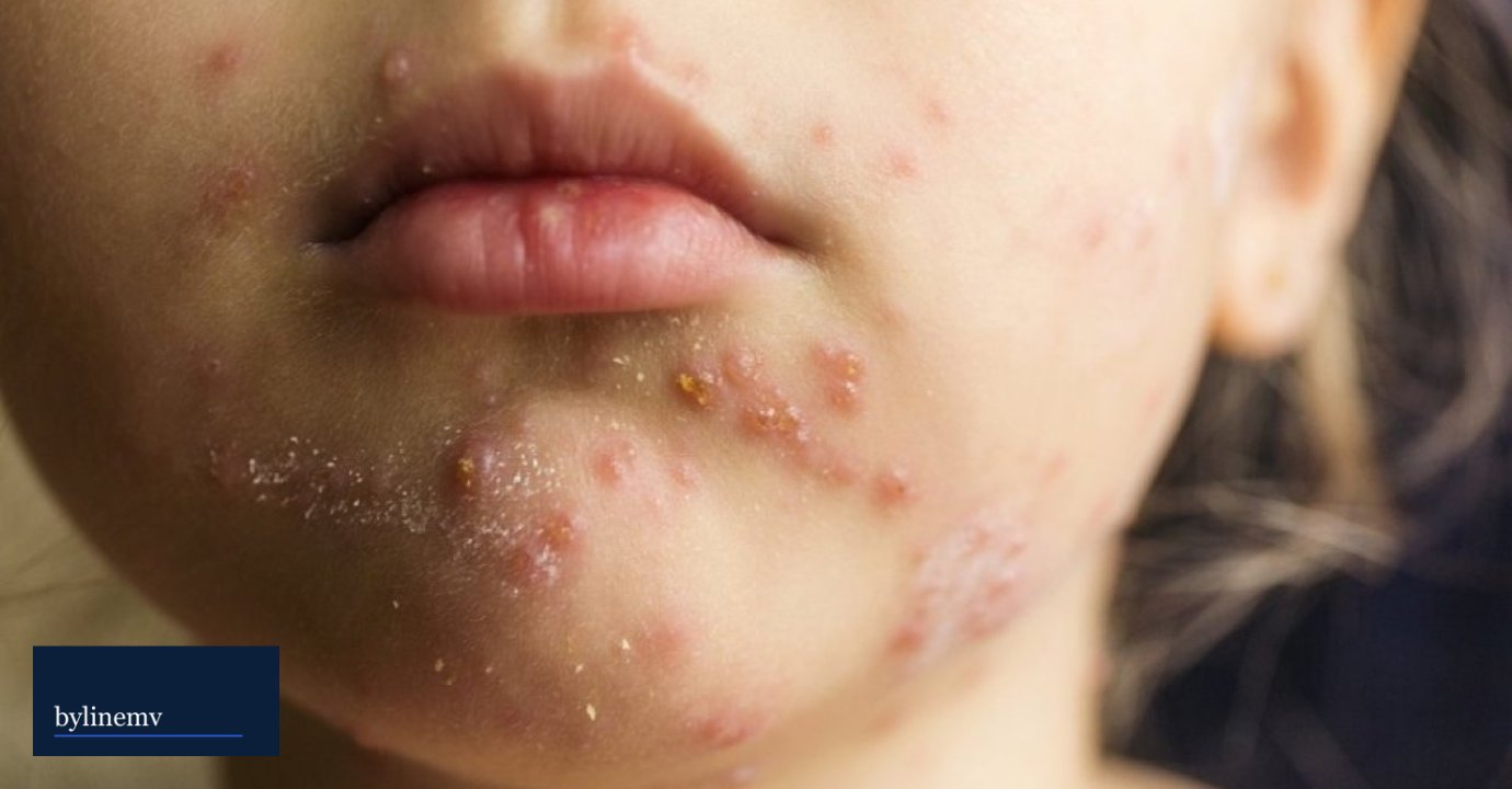 HPA confirms 2 more measles cases, total up to 11