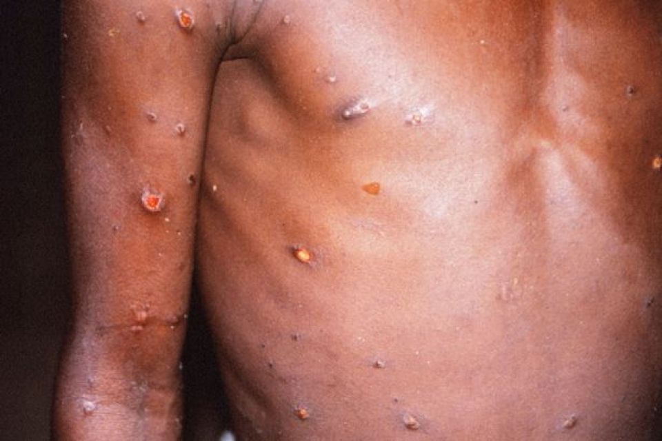 Monkeypox Raajje in fenun ekasheegenvey, samaaluvey: HPA