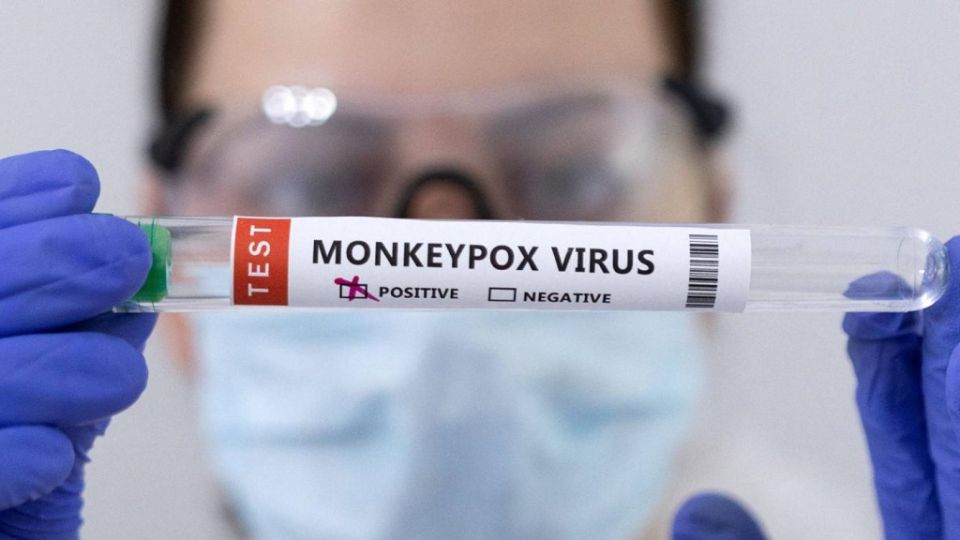 Monkeypox: bali jessun ekashi gen vaa virus, hospital kotari thakugai