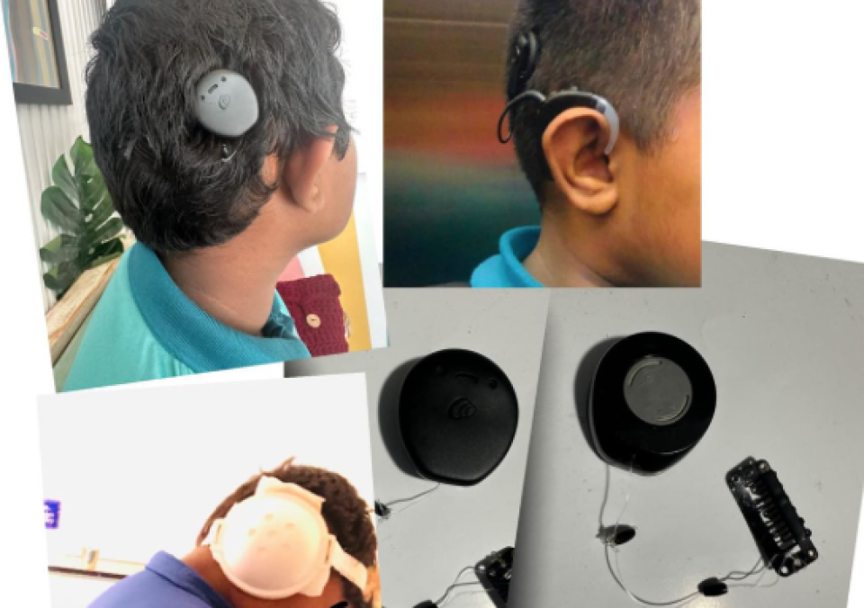 Cochlear implant ge mauloomaath engun muhimmu!