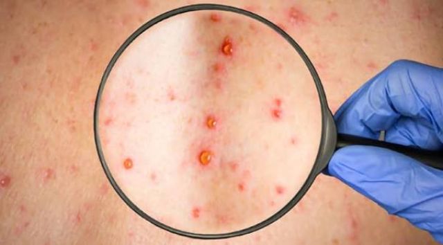 Raajjeygai HIV: Rasmee adhadhuthakaai neygi huri haqeegaiy!