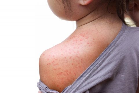 Maldives report third case of measles