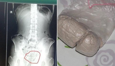 Inmate hides drugs in  his rectum to smuggle it to Maafushi jail