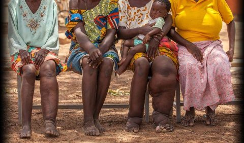 Screening underway for those  from Filariasis rampant countries
