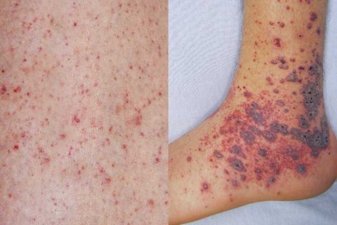 Meningococcal Case: HPA confirm no other case detected