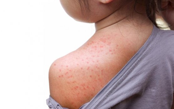 HPA reports another measles case