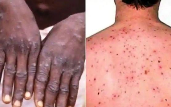 Monkeypox: case ithuruve, WHO inn kulli badhaluvumakah govaalaifi