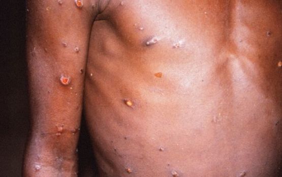 Monkeypox Raajje in fenun ekasheegenvey, samaaluvey: HPA