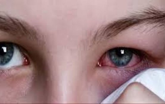 HPA warns of rise in Conjunctivitis cases