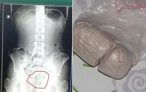 Inmate hides drugs in  his rectum to smuggle it to Maafushi jail