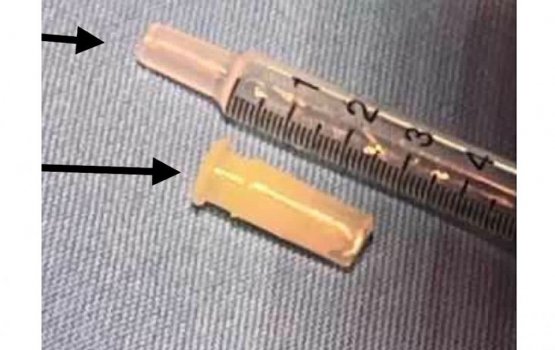 IGMH doctors remove a whistle from a child's lungs