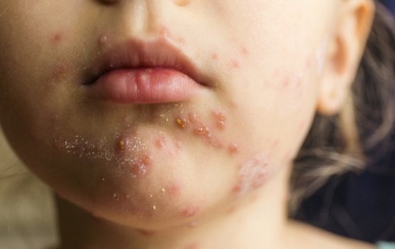 HPA reports a case of measles, urges caution