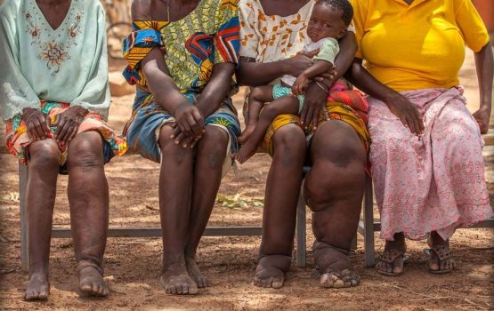 Screening underway for those  from Filariasis rampant countries