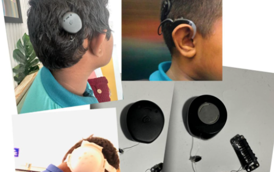 Cochlear implant ge mauloomaath engun muhimmu!