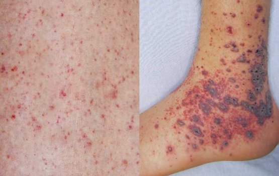 Meningococcal Case: HPA confirm no other case detected