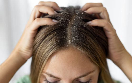 LIFESTYLE: Dandruff nuvatha bolun han folhumun salaamaih vaanee kihineh?
